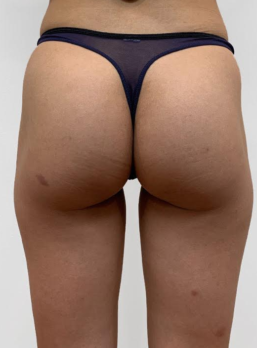Before — buttock contour enhanced, rear view