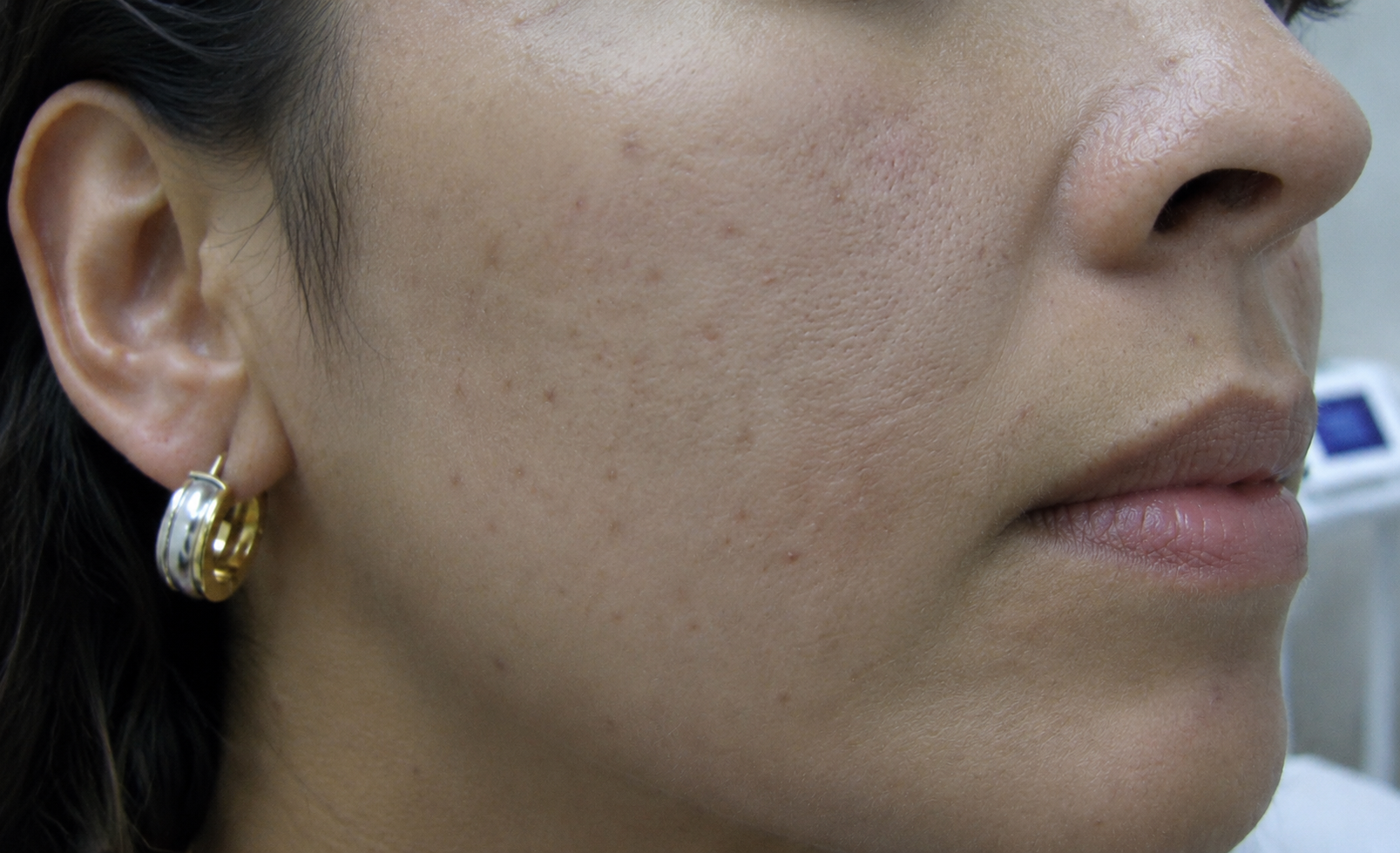 After — skin texture and tone refined with a chemical peel, Glam Medspa Sunnyvale