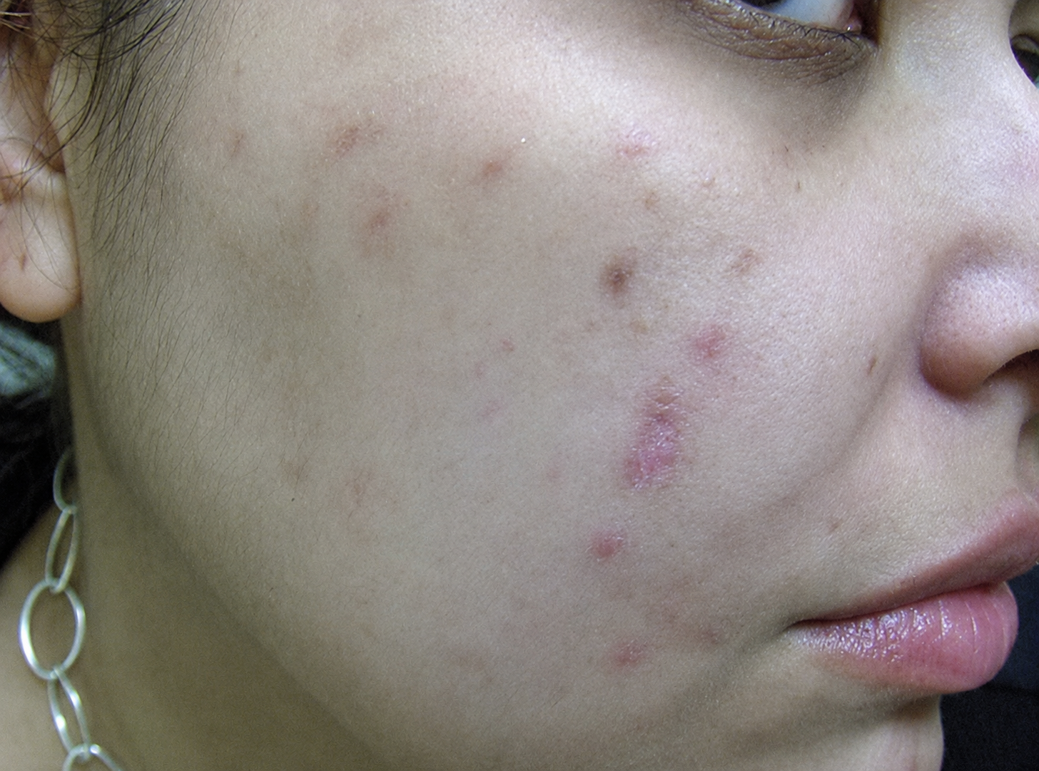 Before — acne and blemishes cleared with a chemical peel