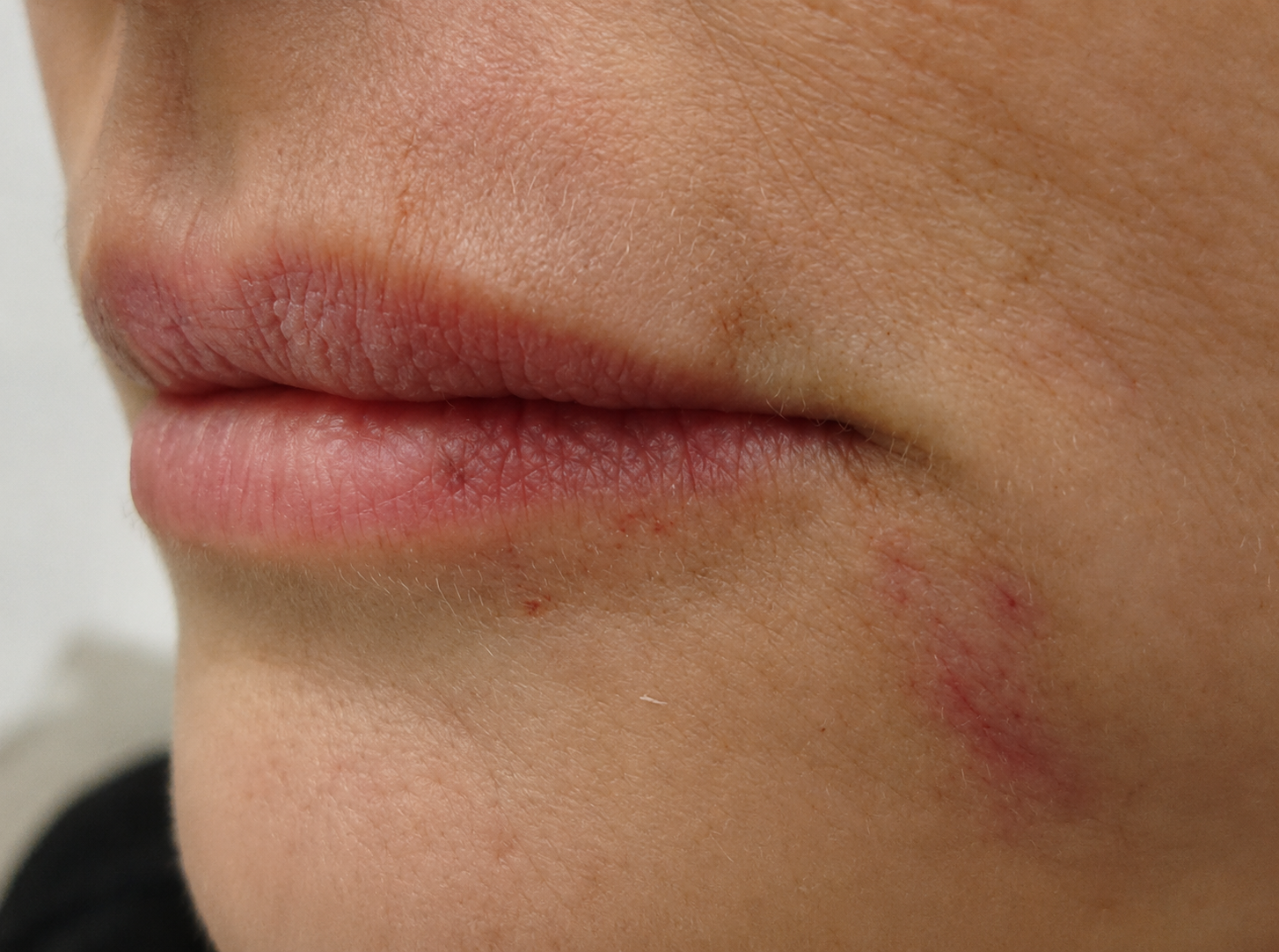 After — lip volume restored with dermal filler, Glam Medspa Sunnyvale