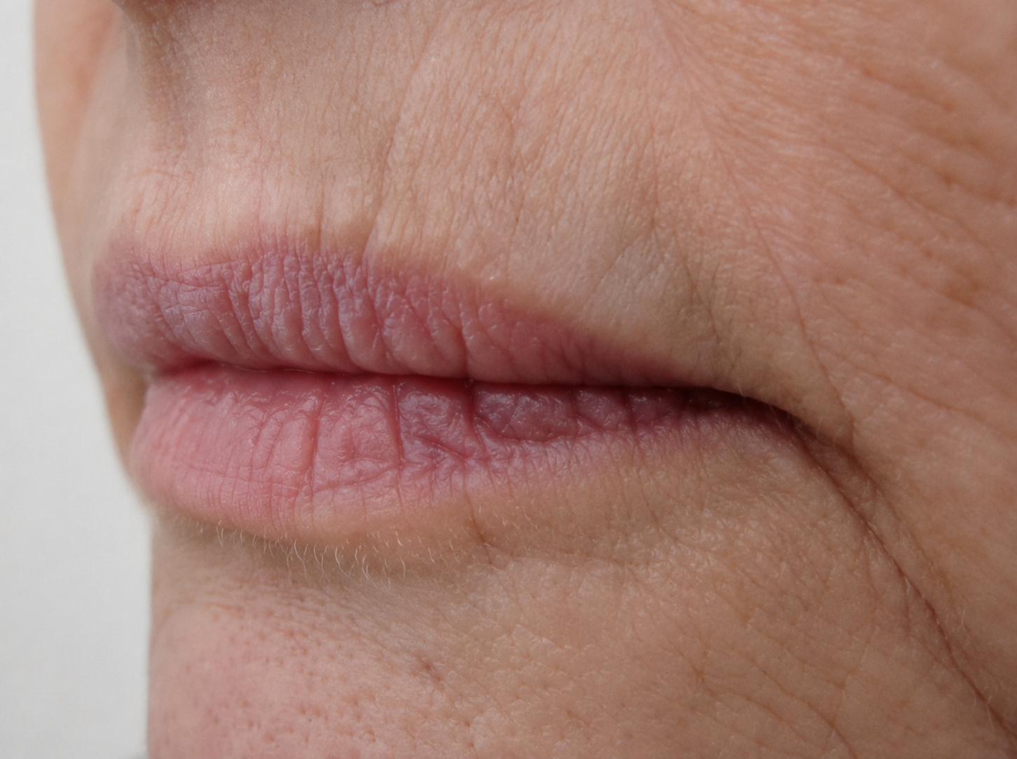 Before — lip volume restored with dermal filler