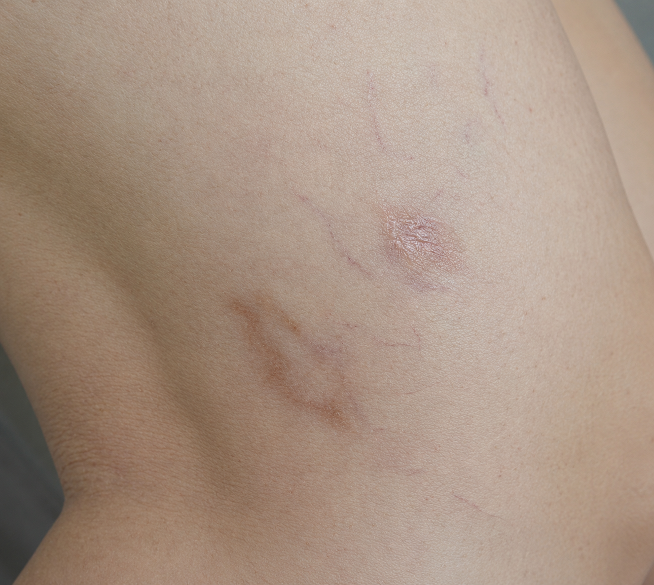 After — thigh spider veins treated with sclerotherapy, Glam Medspa Sunnyvale