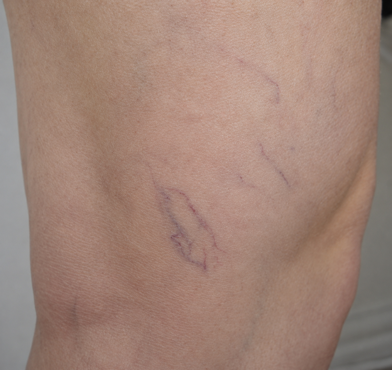 Before — thigh spider veins treated with sclerotherapy