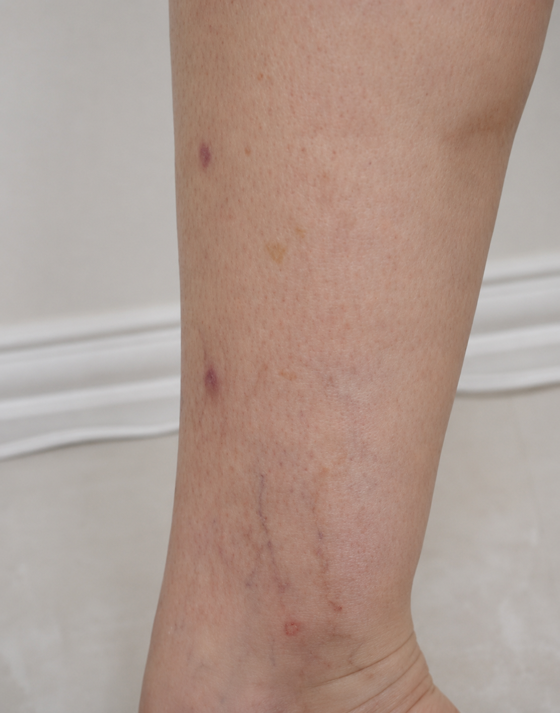 After — ankle veins cleared with sclerotherapy, Glam Medspa Sunnyvale