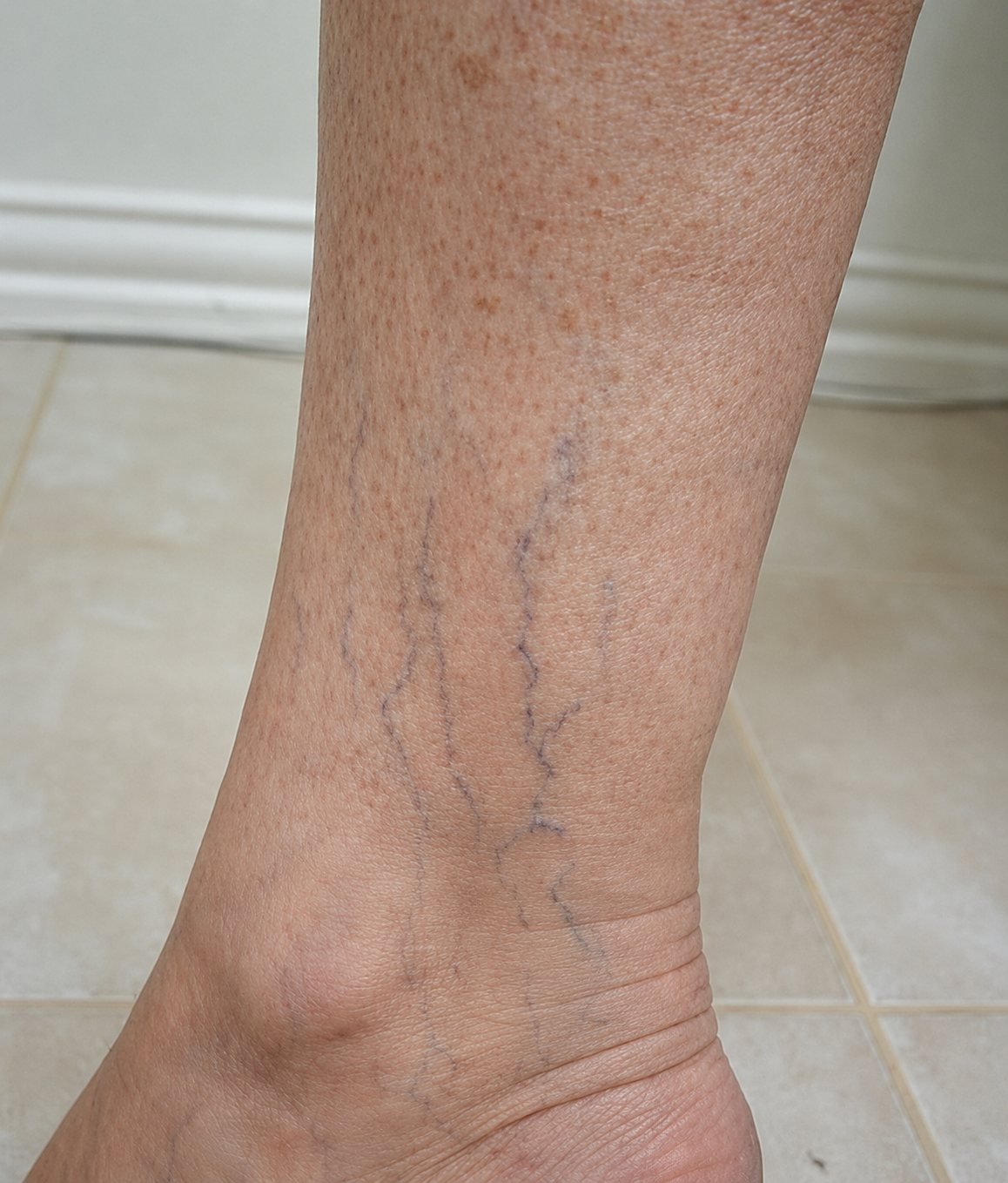 Before — ankle veins cleared with sclerotherapy